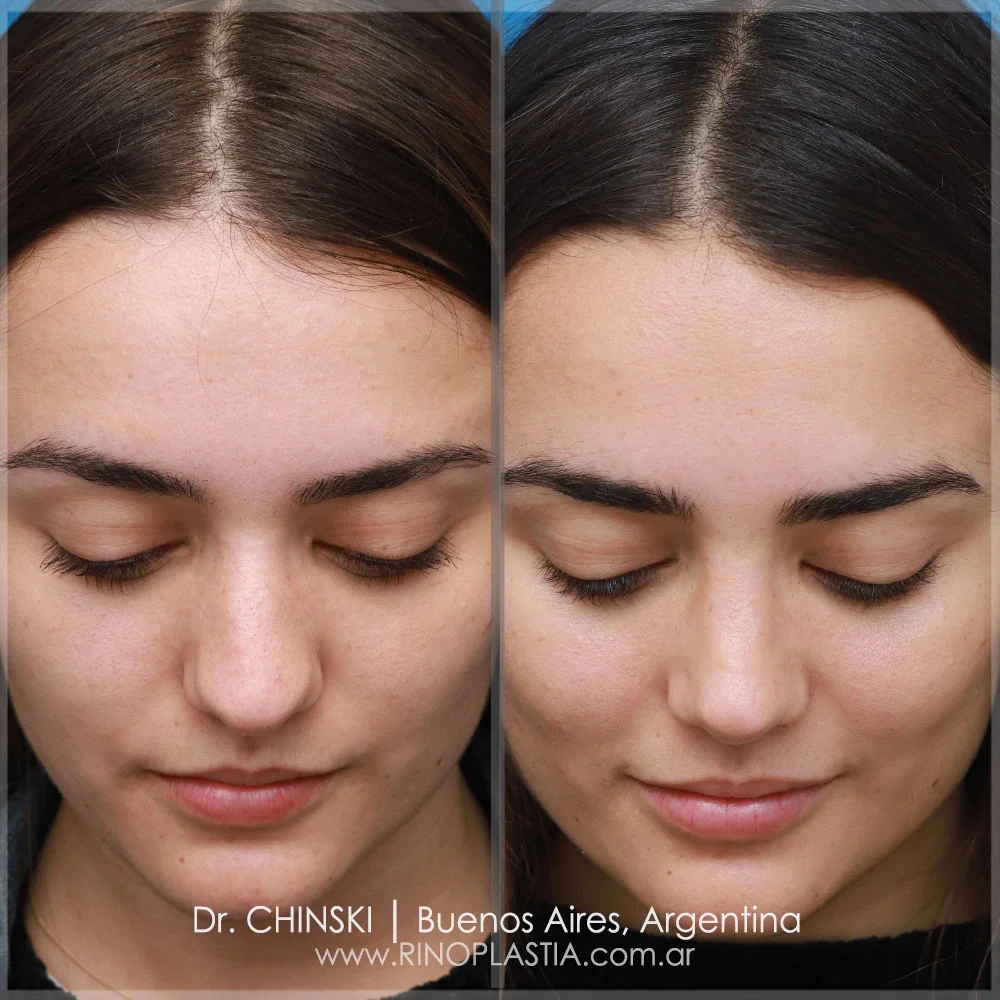 Antes e depois de rinoplastia – caso 142