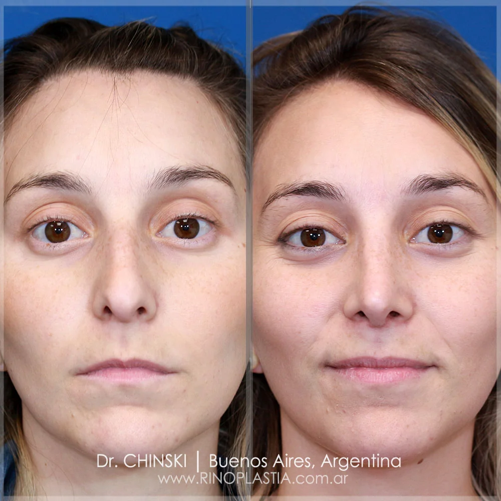 Antes e depois de rinoplastia – caso 143