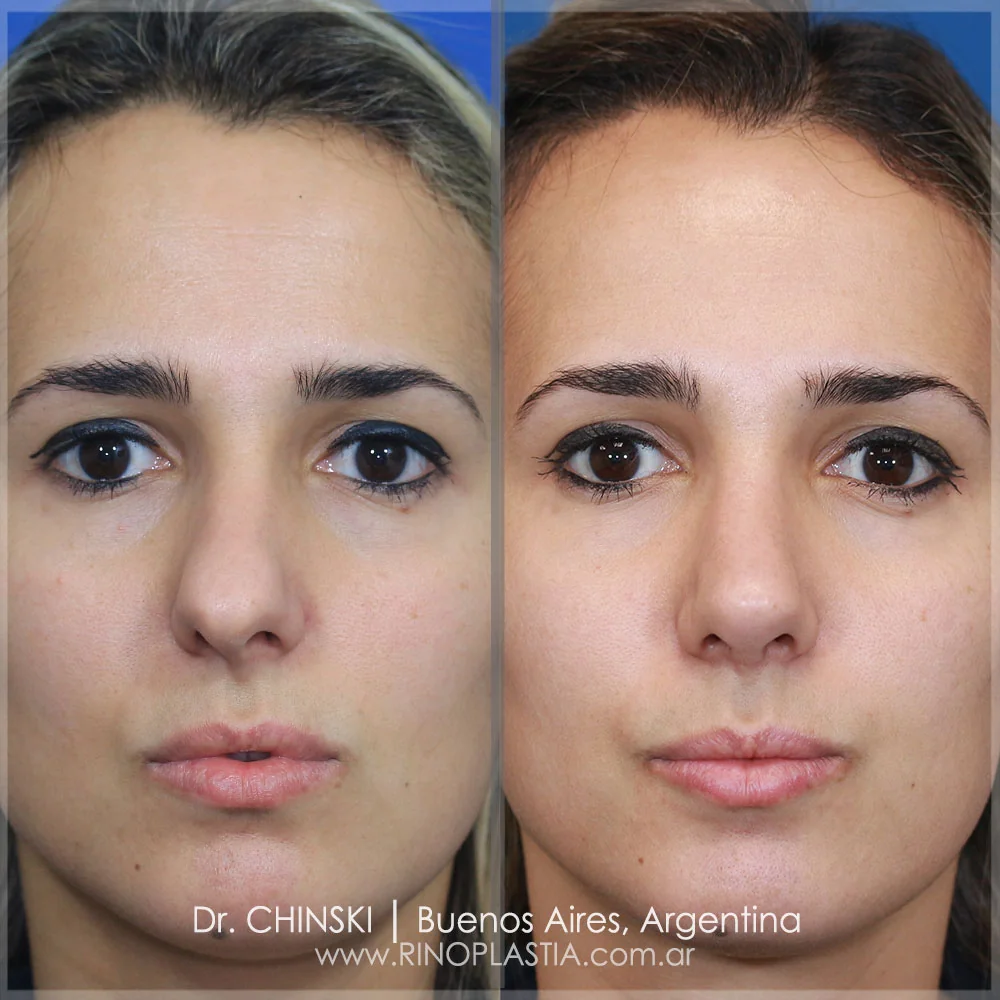 Antes e depois de rinoplastia – caso 144