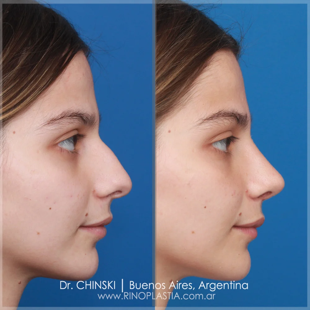Rhinoplasty before and after – case 145
