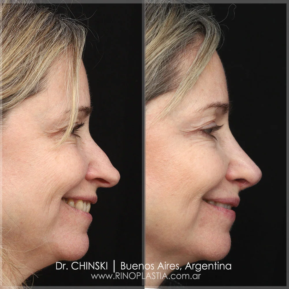 Rhinoplasty before and after – case 146