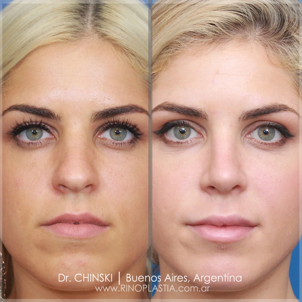 Antes e depois de rinoplastia – caso 147