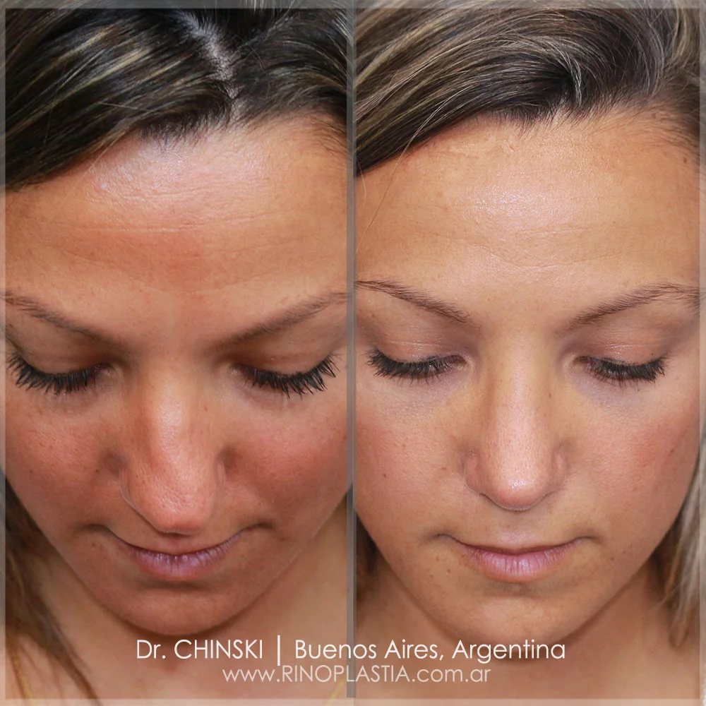 Antes e depois de rinoplastia – caso 148