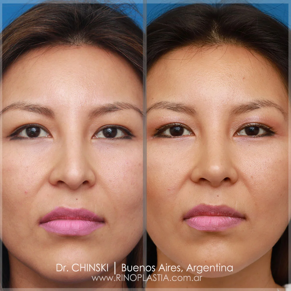 Antes e depois de rinoplastia – caso 149