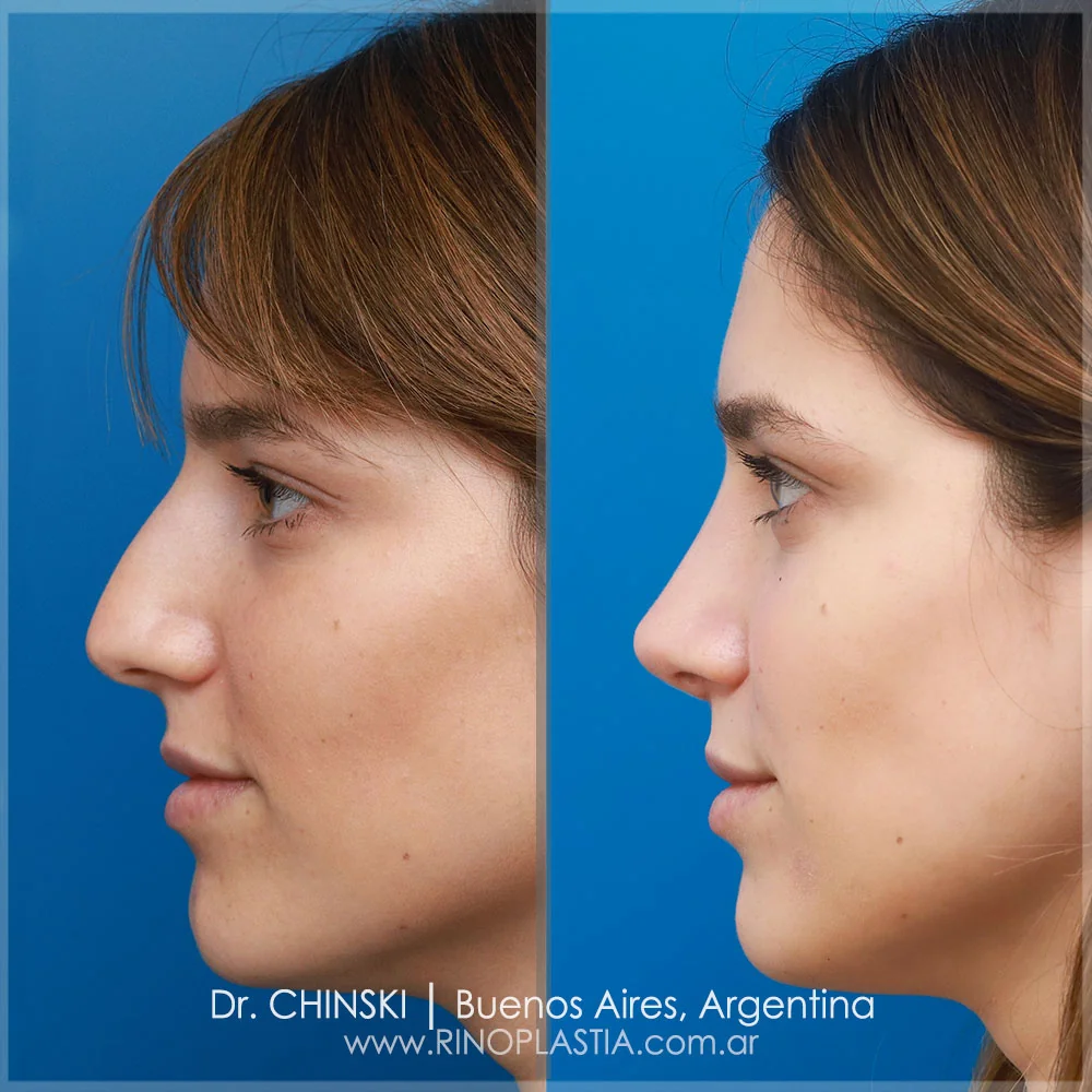 Rhinoplasty before and after – case 15