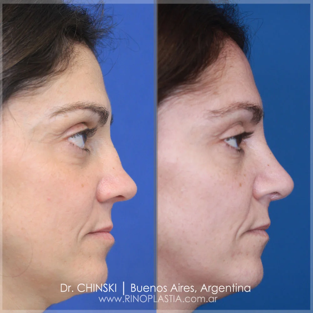 Rhinoplasty before and after – case 150
