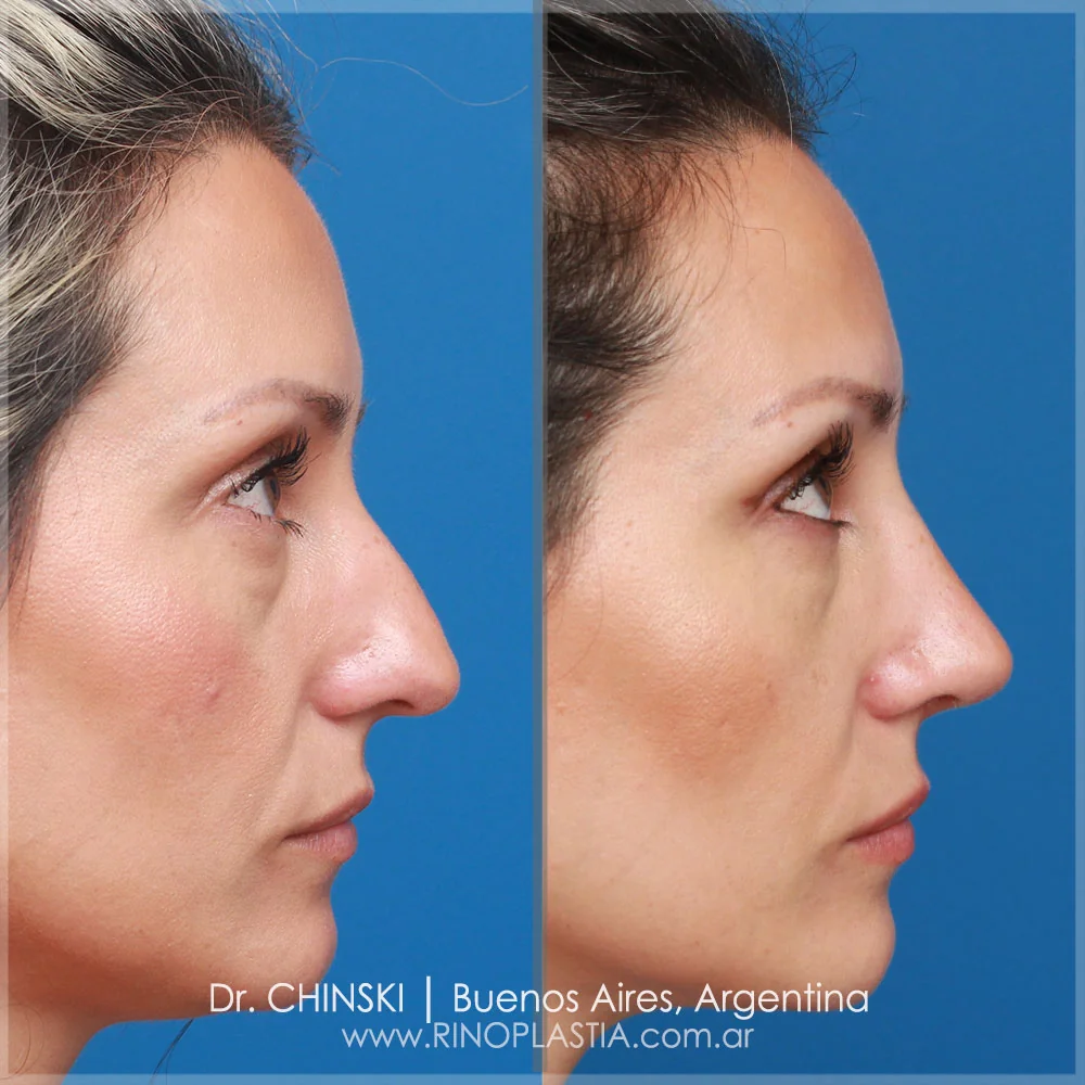 Antes e depois de rinoplastia – caso 151