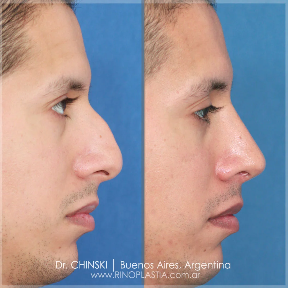 Antes e depois de rinoplastia – caso 152