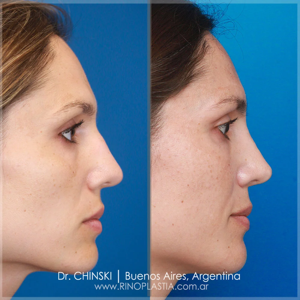 Antes y después de rinoplastia – caso 153