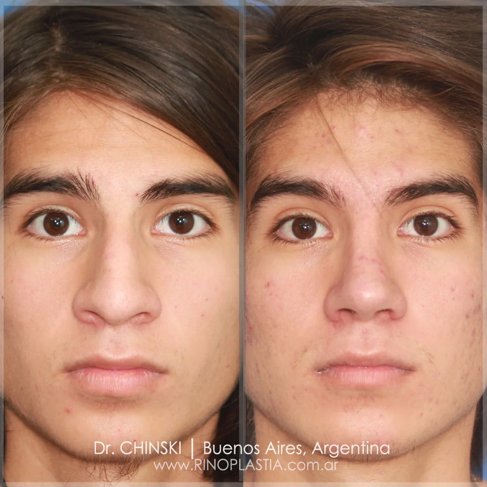 Antes e depois de rinoplastia – caso 154