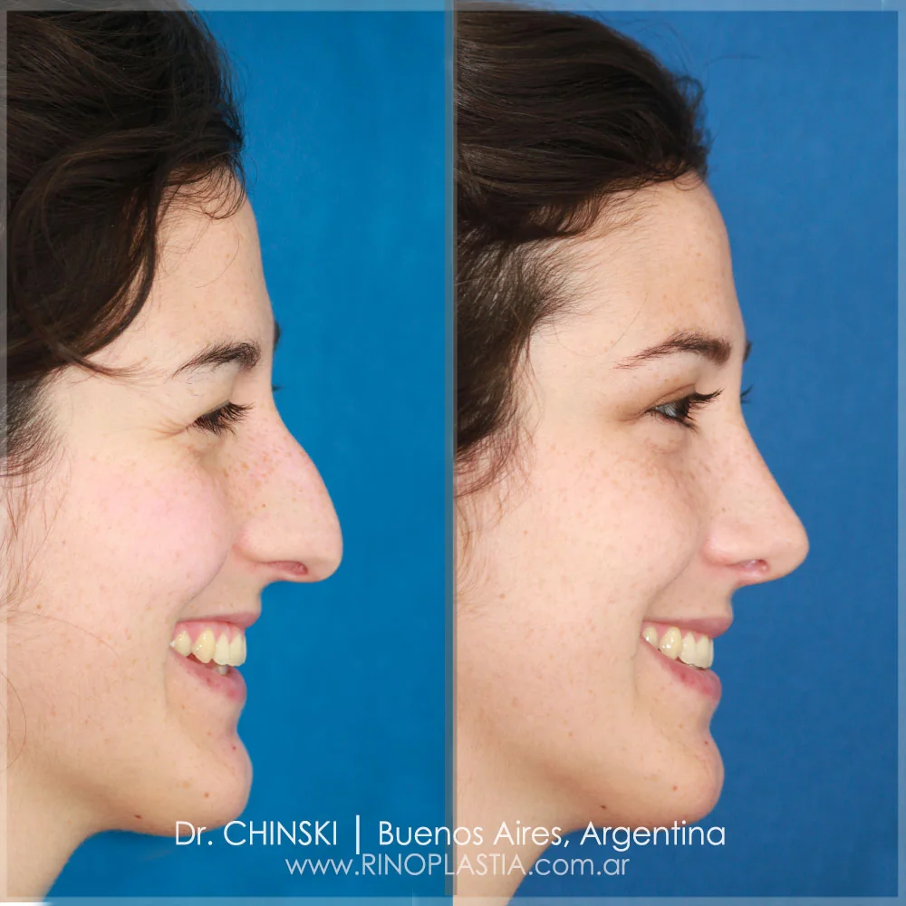 Antes e depois de rinoplastia – caso 155