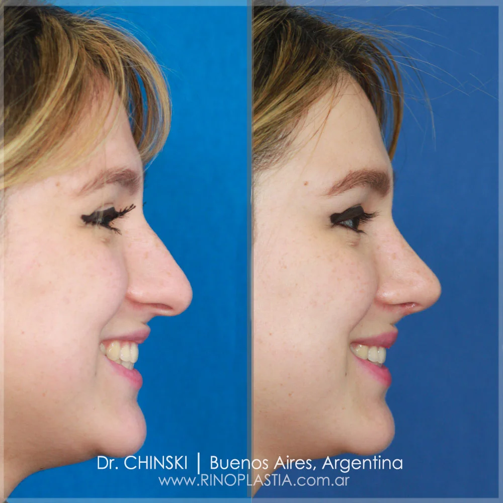 Rhinoplasty before and after – case 156