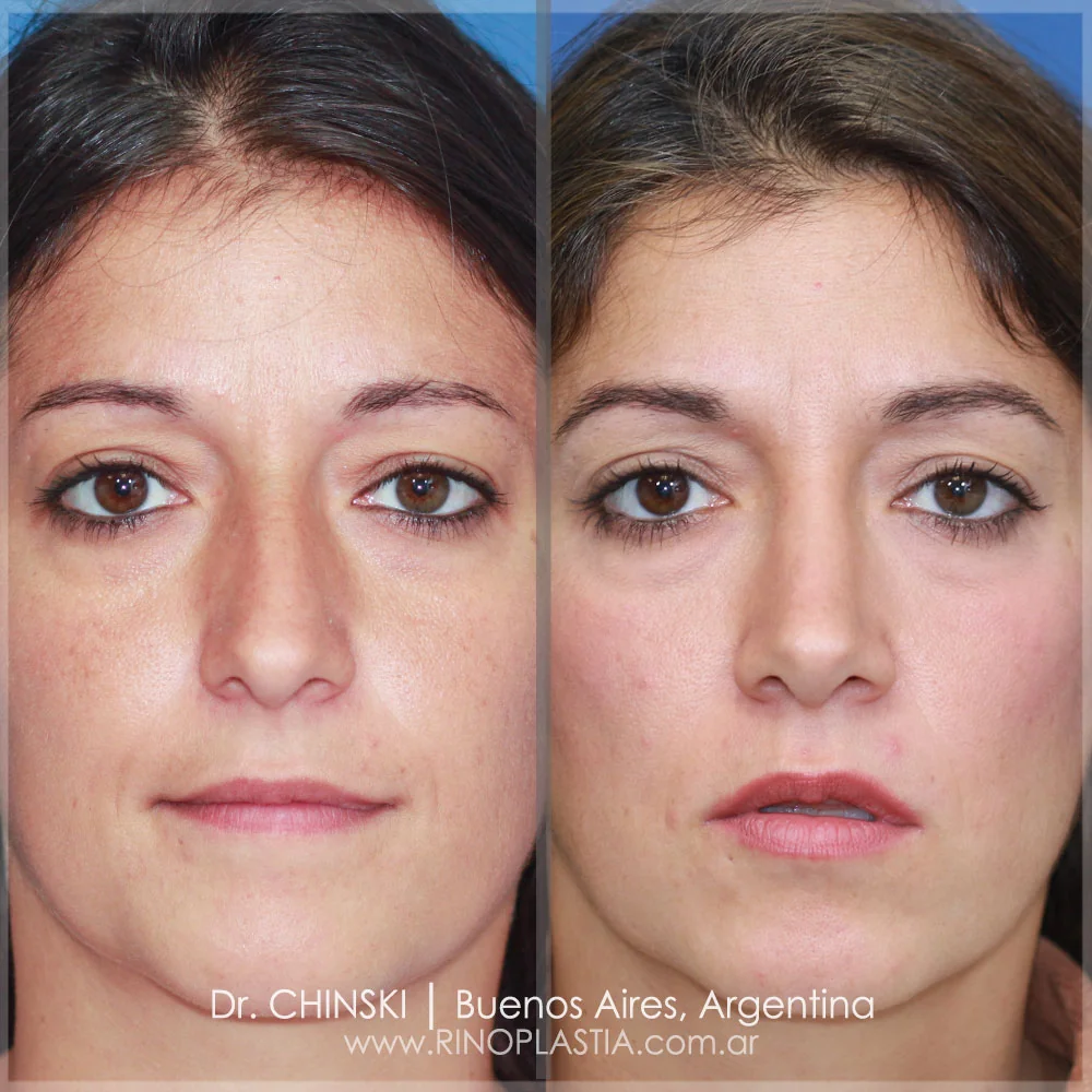 Antes e depois de rinoplastia – caso 157