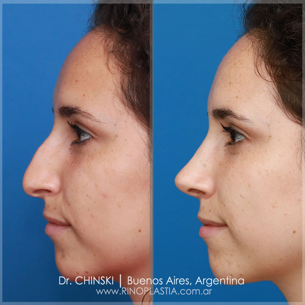 Rhinoplasty before and after – case 158