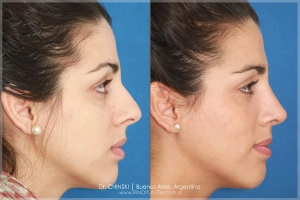 Antes e depois de rinoplastia – caso 159