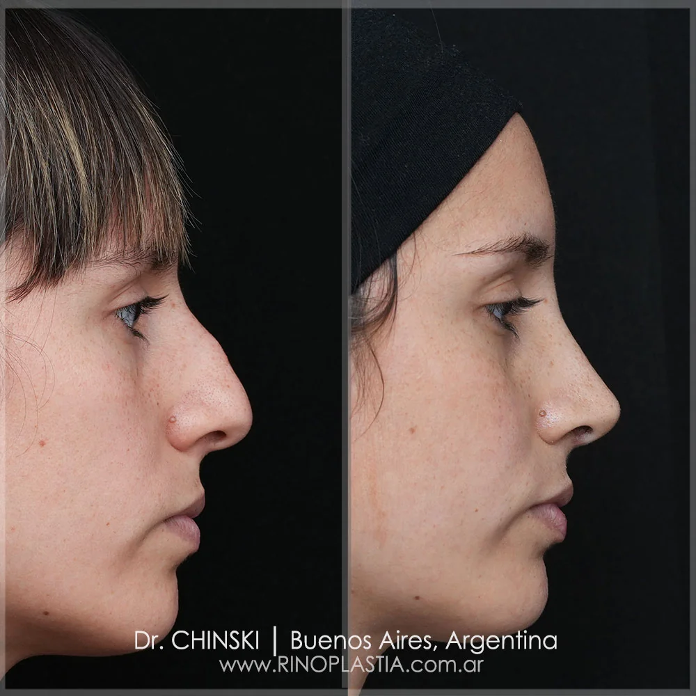 Rhinoplasty before and after – case 16