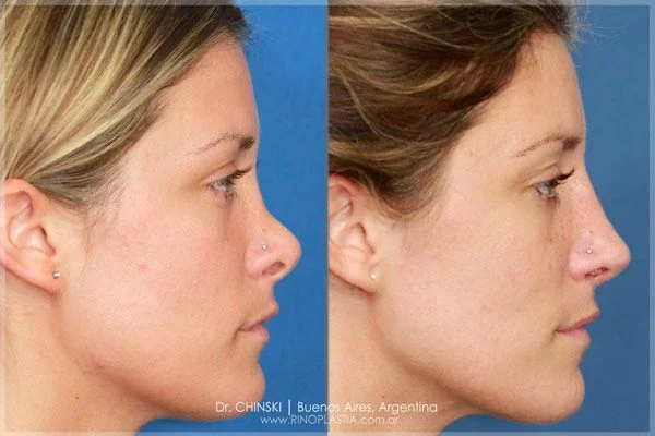 Antes e depois de rinoplastia – caso 160