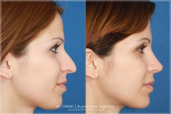Antes e depois de rinoplastia – caso 161