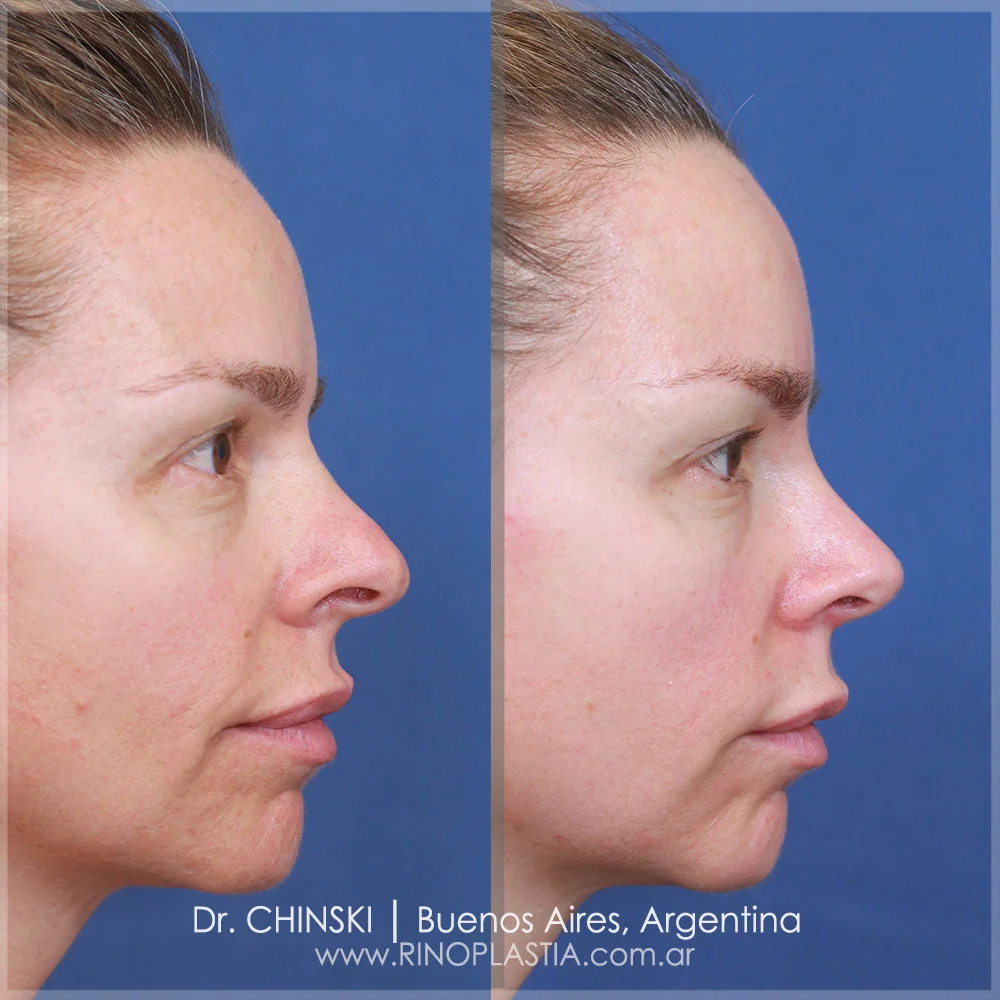 Antes e depois de rinoplastia – caso 162