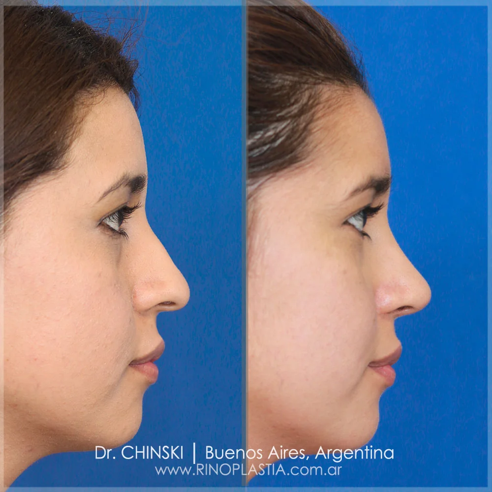 Antes e depois de rinoplastia – caso 163