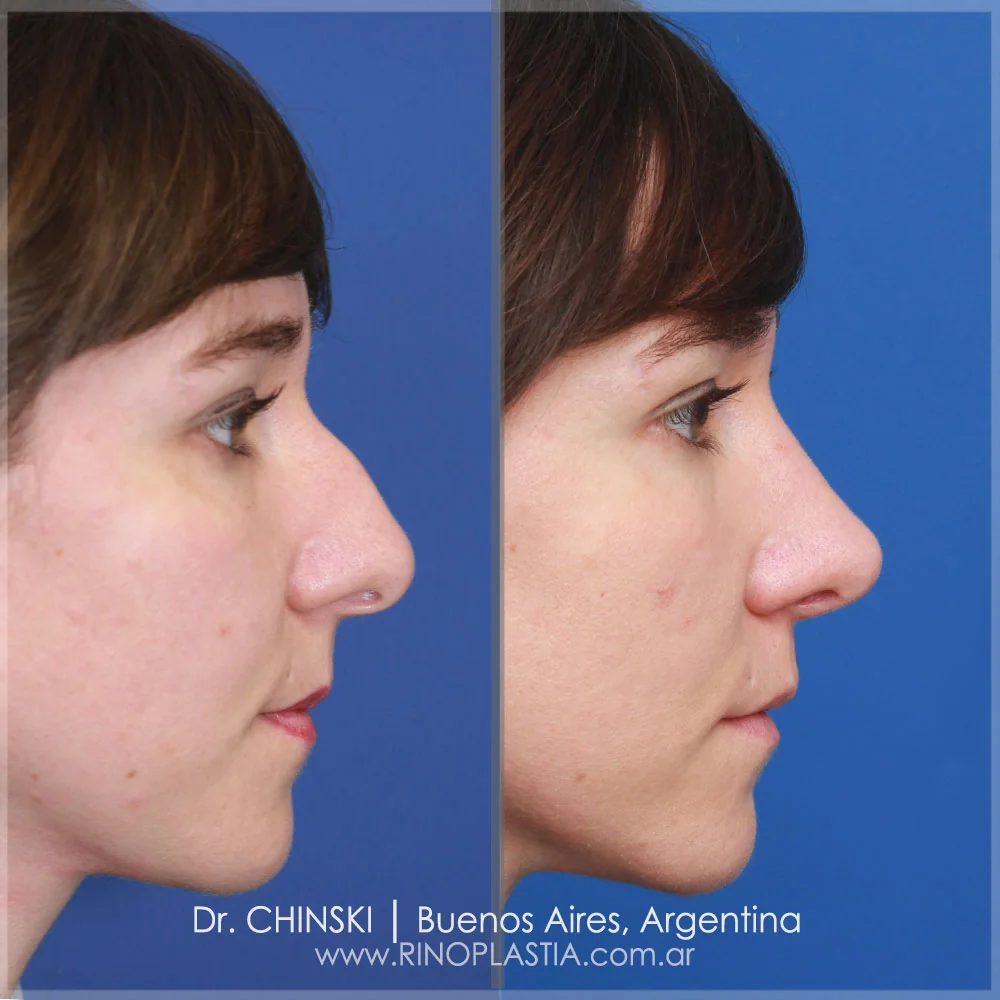 Antes e depois de rinoplastia – caso 164