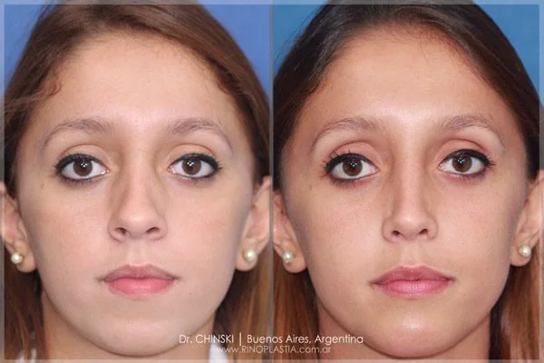 Antes e depois de rinoplastia – caso 165
