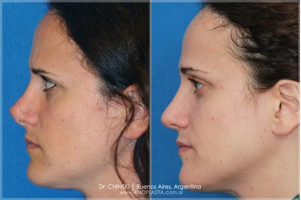 Antes e depois de rinoplastia – caso 166
