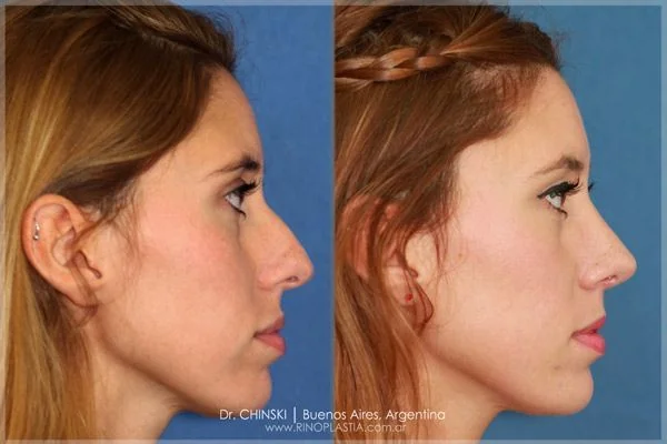 Rhinoplasty before and after – case 167