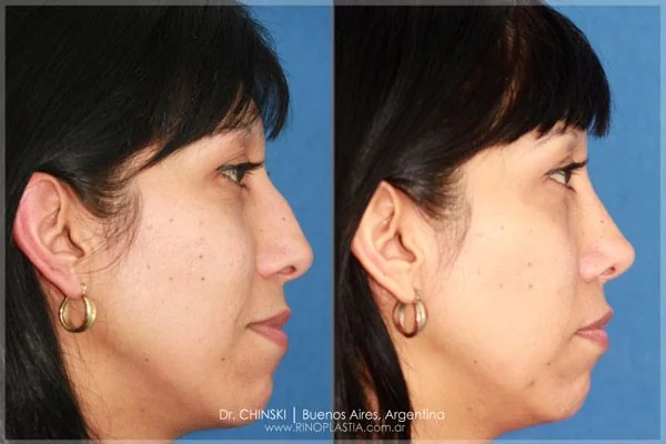Antes e depois de rinoplastia – caso 168