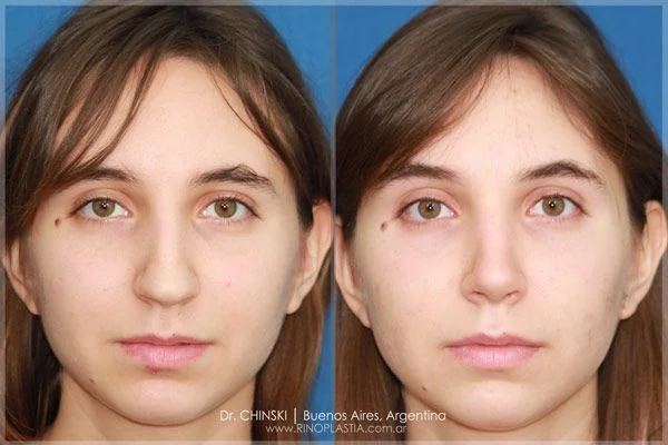 Antes e depois de rinoplastia – caso 169