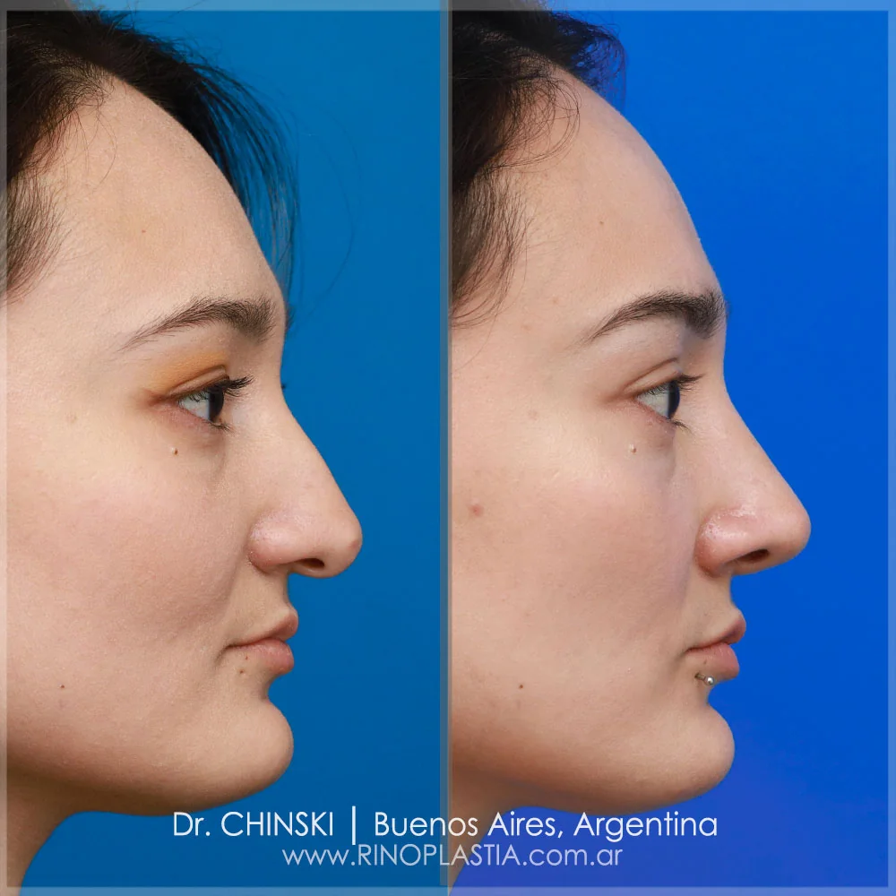 Rhinoplasty before and after – case 17