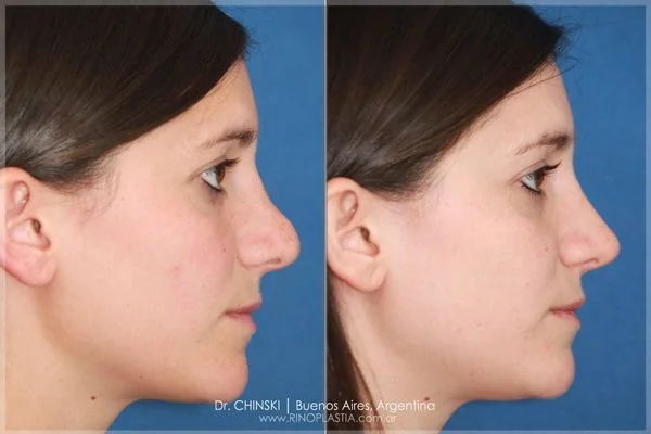 Antes e depois de rinoplastia – caso 170