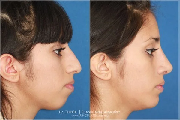 Rhinoplasty before and after – case 171