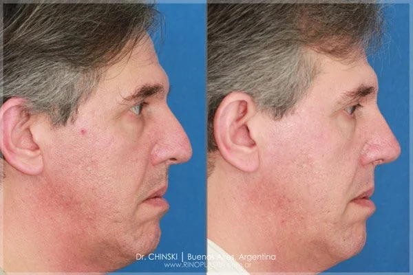 Antes e depois de rinoplastia – caso 172