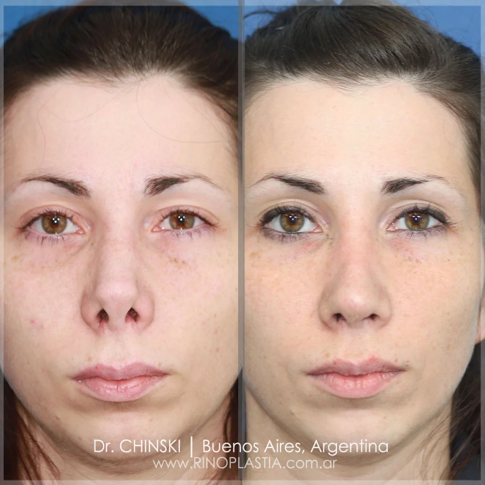 Antes y después de rinoplastia – caso 173