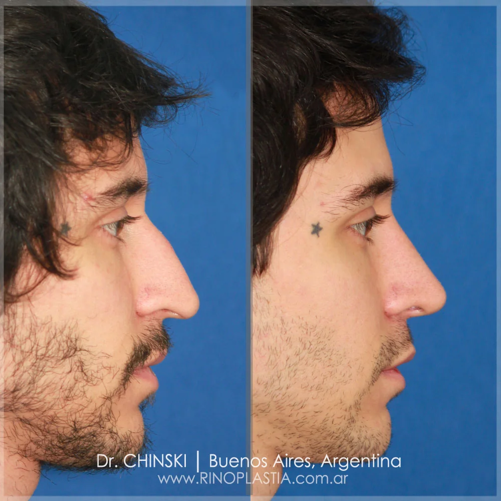 Antes e depois de rinoplastia – caso 174