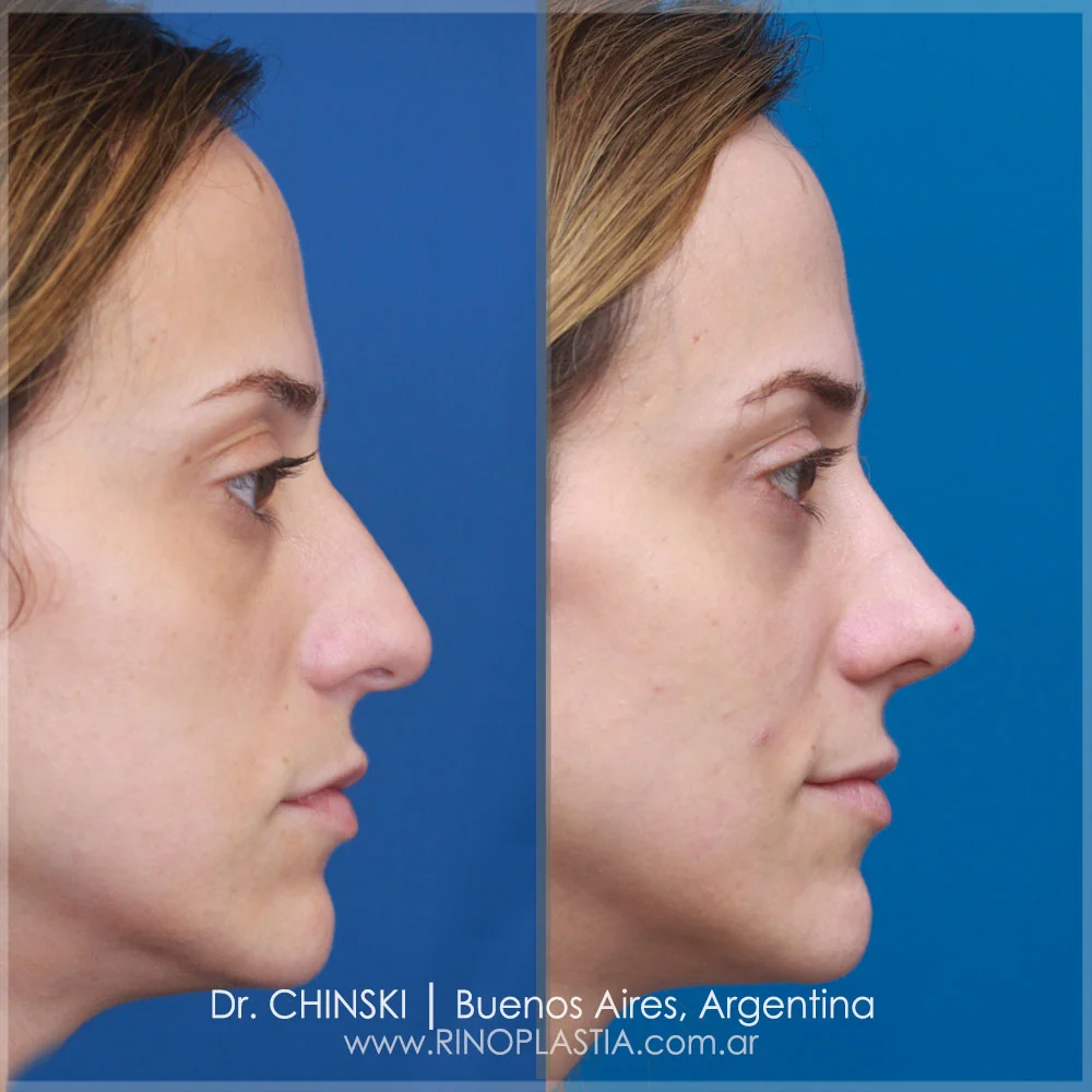 Antes e depois de rinoplastia – caso 175