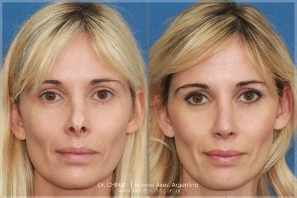Rhinoplasty before and after – case 176