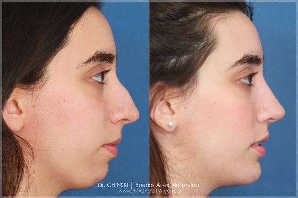 Rhinoplasty before and after – case 177