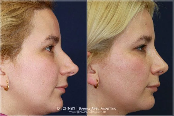 Rhinoplasty before and after – case 178