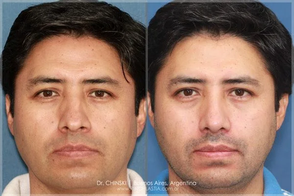 Rhinoplasty before and after – case 179