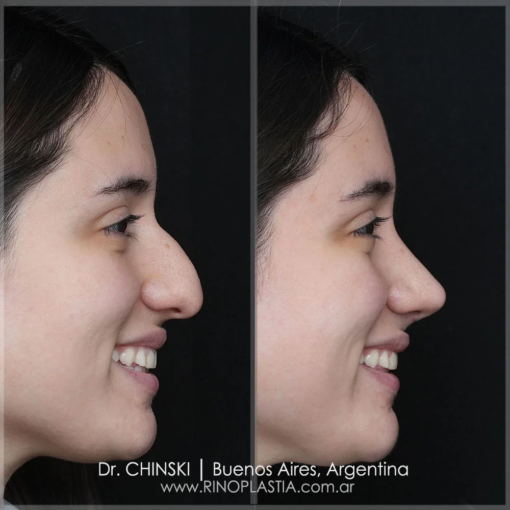 Rhinoplasty before and after – case 18
