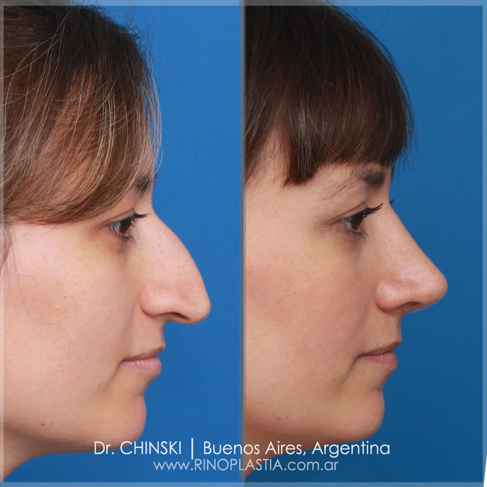 Rhinoplasty before and after – case 180