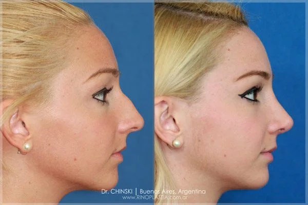 Rhinoplasty before and after – case 181