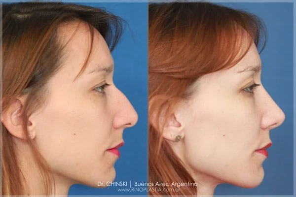 Rhinoplasty before and after – case 182