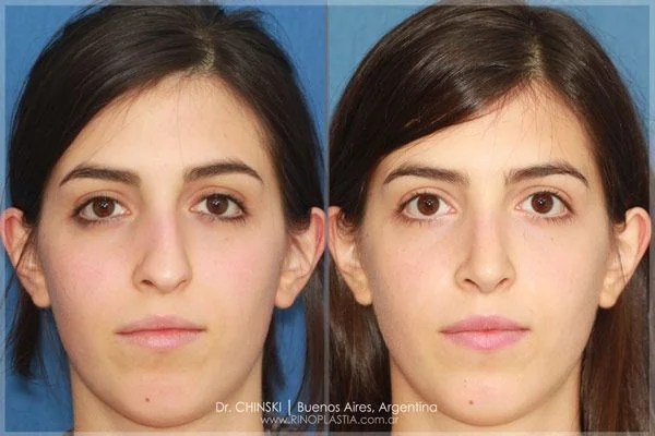 Rhinoplasty before and after – case 183
