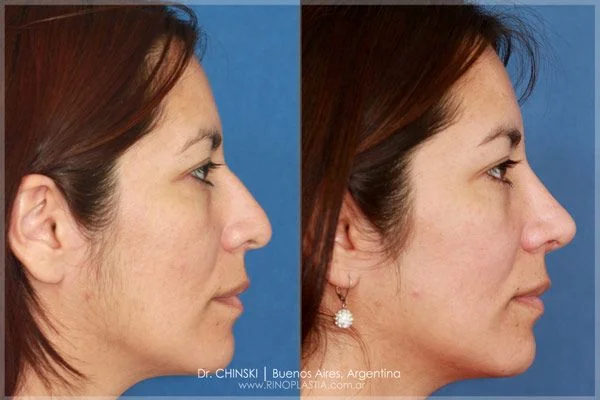 Antes e depois de rinoplastia – caso 184