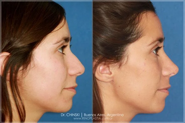 Antes e depois de rinoplastia – caso 185