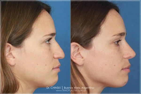 Antes y después de rinoplastia – caso 186
