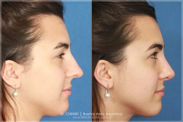 Antes e depois de rinoplastia – caso 187